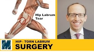 Hip Pain  Torn Labrum Hip [upl. by Craggy]