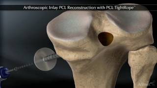 Ligamentopastie du ligament croisé postérieur  Dr Philippe Loriaut [upl. by Audwin]