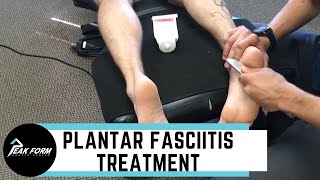 Plantar Fasciitis Treatment San Diego Graston Chiropractic [upl. by Ris]