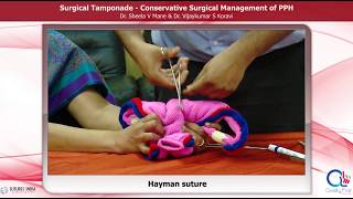 Surgical Management of PPH by Dr Sheela Mane [upl. by Leirad85]