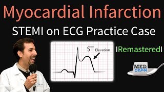 Myocardial Infarction  STEMI on ECG  Practice EKG [upl. by Hussey793]