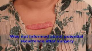 Chest Keloids  Mistakes to Avoid [upl. by Sand]