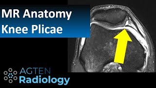 MRI Anatomy of Knee Plicae [upl. by Eycats568]