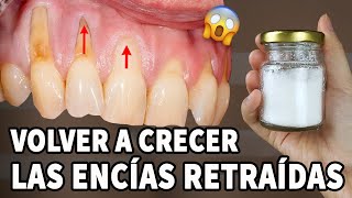 ¡Increíble Este Es Un Remedio Casero Para Las Encías Retraídas [upl. by Neirad722]