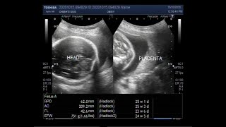 Placenta positions during pregnancy Anterior and posterior placenta se boy or girl myths [upl. by Yllib531]