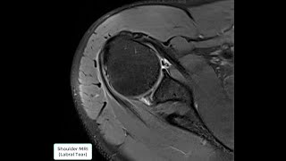 Shoulder MRI Labral Tear [upl. by Artinak494]