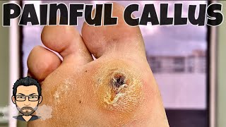 CALLUS REMOVAL FROM FEET [upl. by Oilalue]