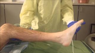 Ankle clonus [upl. by Dhu]