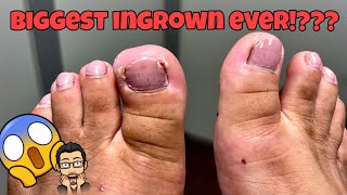 DOUBLE INGROWN TOENAIL REMOVAL 😥😰 [upl. by Afton]