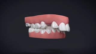 Invisalign® Treatment with Manidublar Advancement [upl. by Ecallaw241]