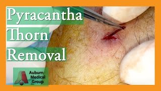 Foreign Body Removal of Pyracantha Thorn  Auburn Medical Group [upl. by Beane]