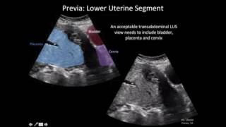 Ultrasound Diagnosis of Placenta Accreta A Tutorial for Imagers [upl. by Diehl]