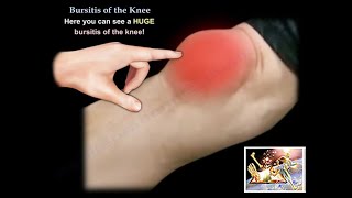 Knee Bursitis  Everything You Need To Know  Dr Nabil Ebraheim [upl. by Bilat]