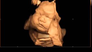 4D to 5D Ultrasound [upl. by Ybloc]