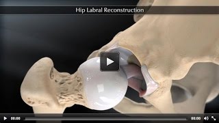 Hip Labral Reconstruction [upl. by Irmgard]