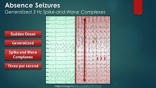 Absence Seizures EEG Findings [upl. by Debby400]