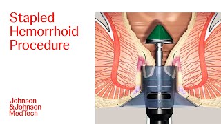 PPH Procedure Animation  Stapled Hemorrhoid Surgery  JampJ MedTech [upl. by Euqitsym]