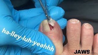 REMOVING A LARGE INGROWN TOENAIL [upl. by Llednov640]