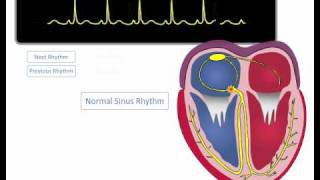 ECG Rhythm Review Sinus Rhythm Sinus Bradycardia Sinus Tachycardia [upl. by Olson]