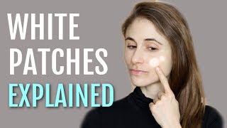 WHITE PATCHES ON THE FACE EXPLAINED PITYRIASIS ALBA DR DRAY [upl. by Yerxa438]