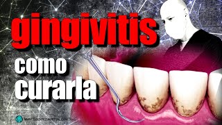 🔵TRATAMIENTO EFECTIVO de la GINGIVITIS y la PERIODONTITIS [upl. by Eenhpad306]