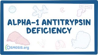 Alpha1 Antitrypsin Deficiency  causes symptoms diagnosis treatment pathology [upl. by Idroj685]