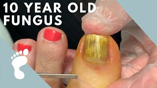 Fungus Takes Over Toenail  Toenail Removal [upl. by Akedijn509]