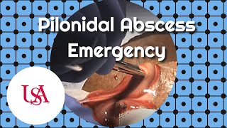 Pilonidal Abscess Emergency Incision amp Drainage [upl. by Reginnej]