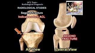 ACL Tears Radiological Evaluation  Everything You Need To Know  Dr Nabil Ebraheim [upl. by Enellek]