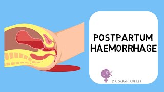 Postpartum Haemorrhage [upl. by Esoranna]